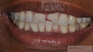 Dental Sports injuries Obeid Dental Chevy Chase MD