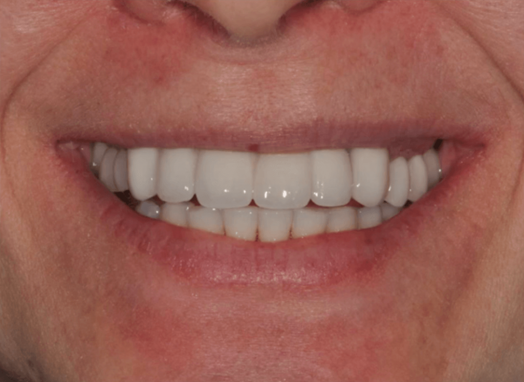 full zirconia dental implants