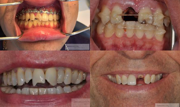 teeth that need Dental Implants