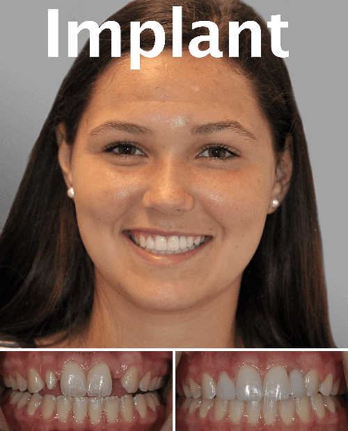 Dental Implants Obeid Dental Chevy Chase