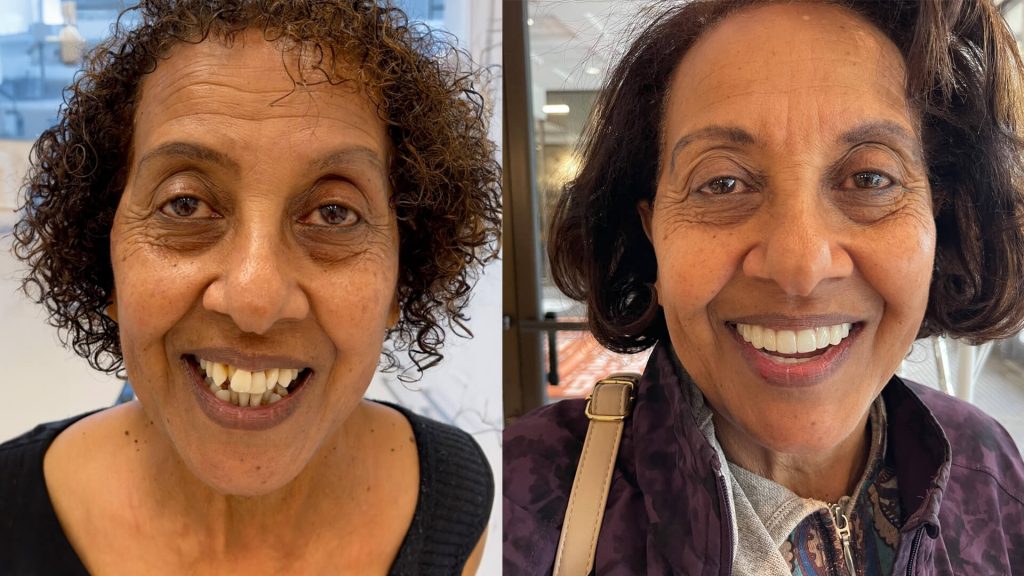 before-after-dental-implants-face