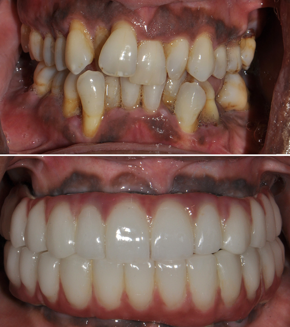 dental implants before and after