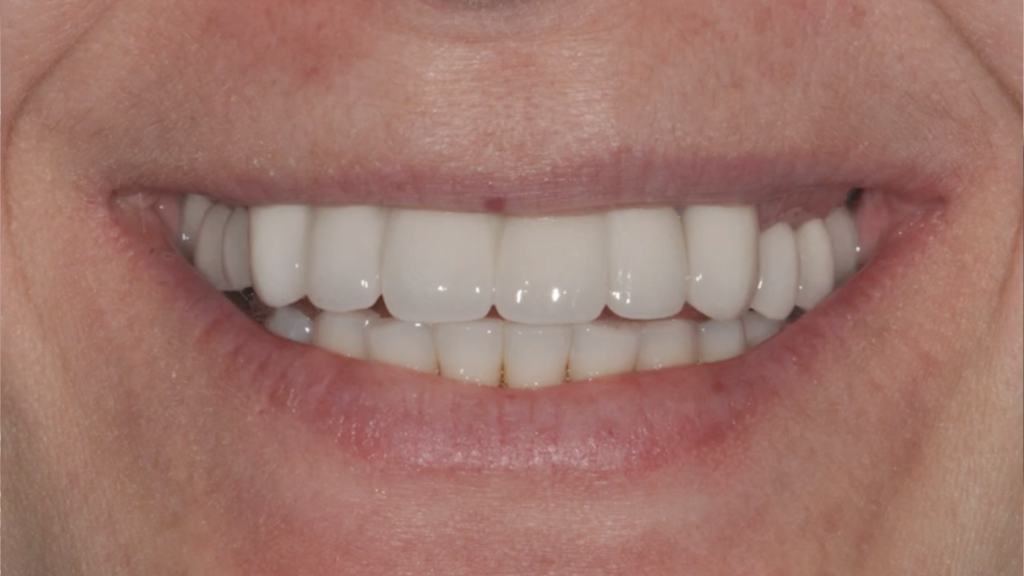 Dental implants smile