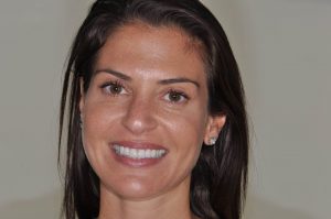 woman smiling with dental veneers