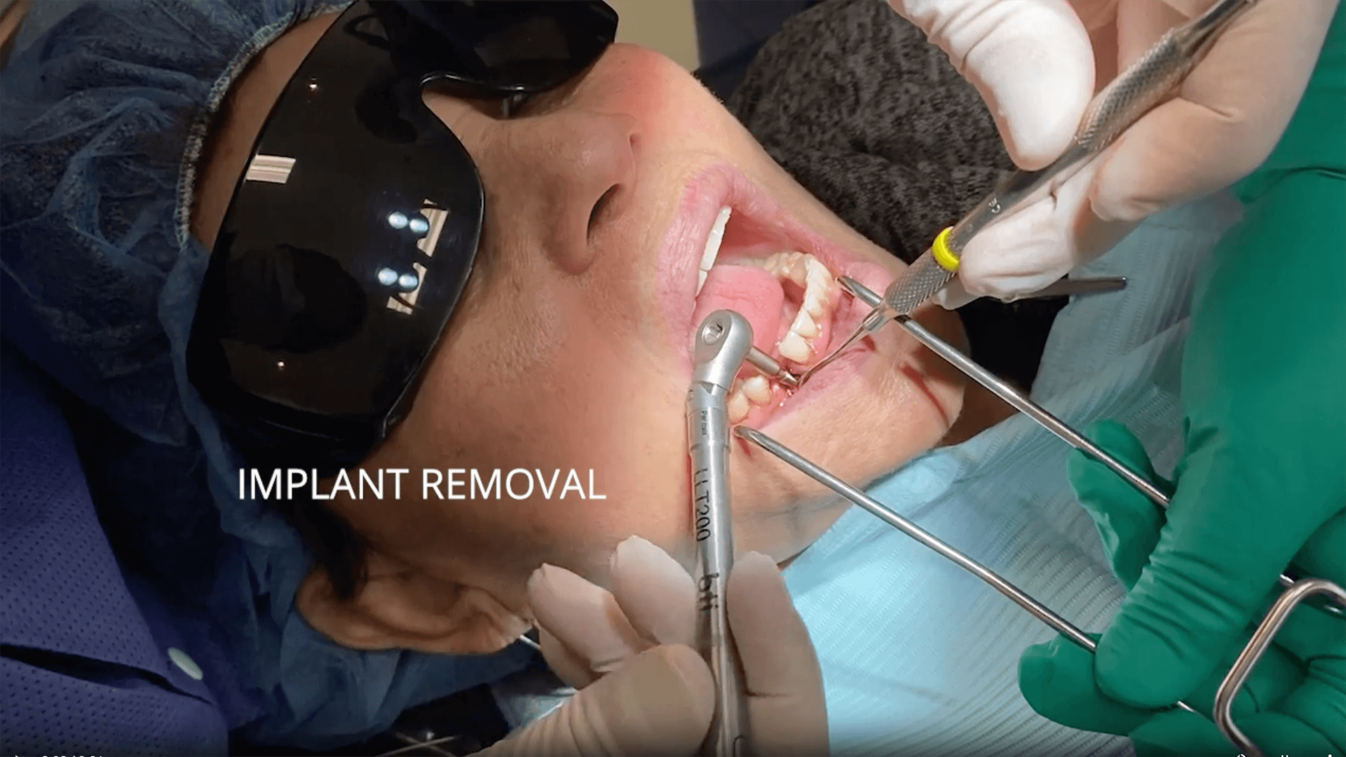 dental patient undergoing a dental implant removal, dental tools unscrewing implant