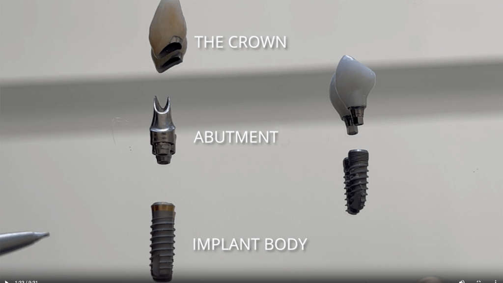 profile view of dental implant appreciating the different parts that make an implant