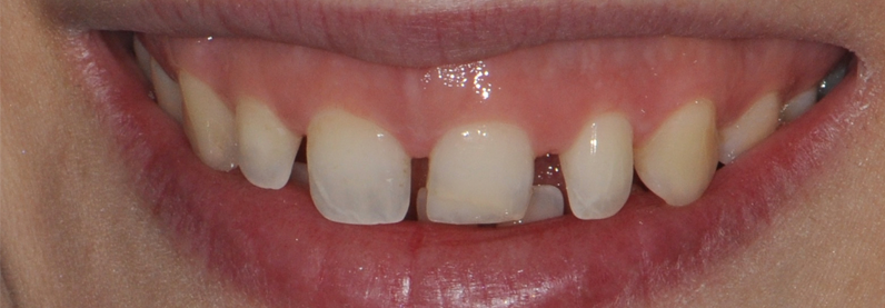 teeth with separations