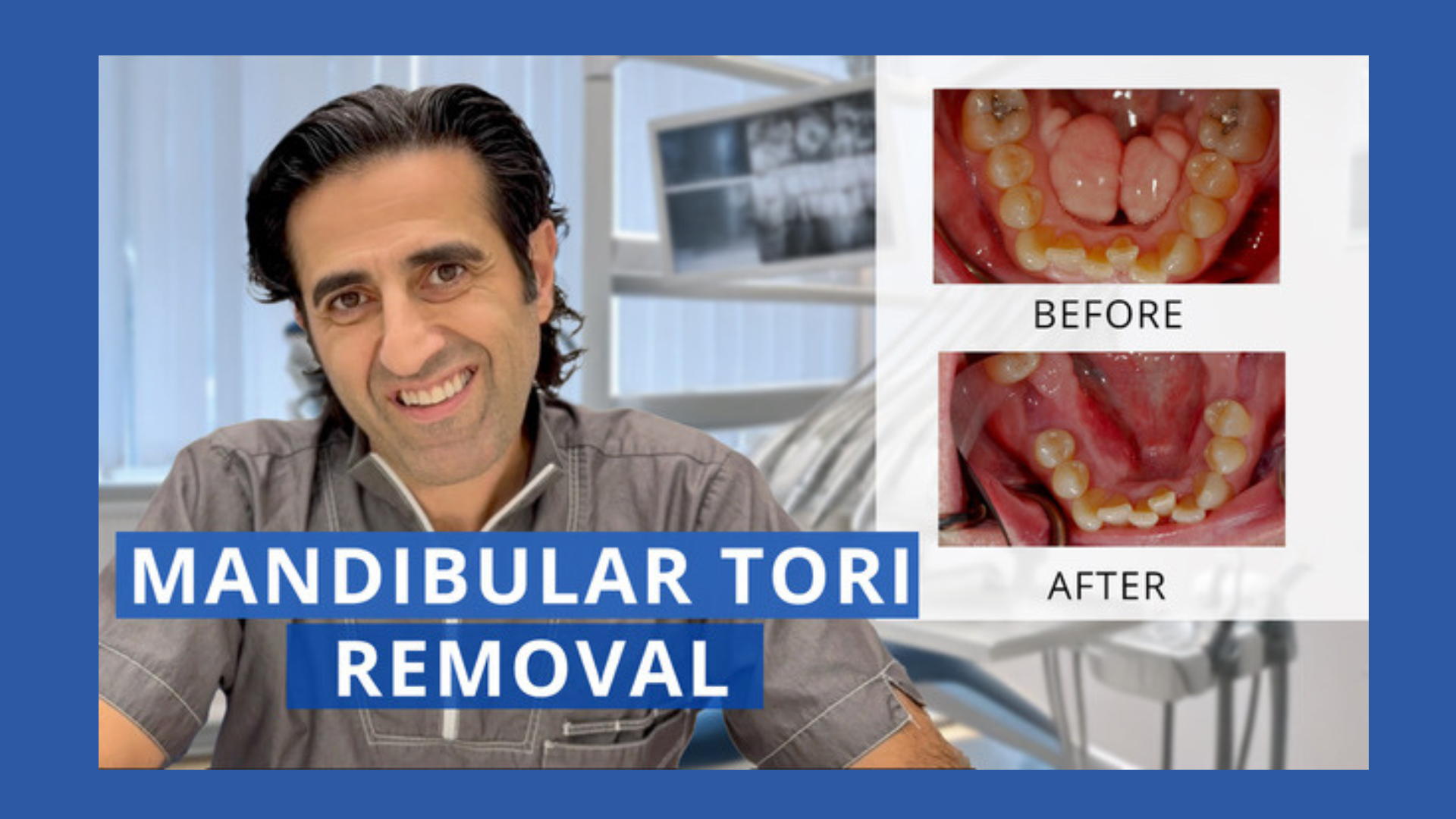 Di And Mandibular Tori Removal UXGH Di And Mandibular Tori Removal UXGH